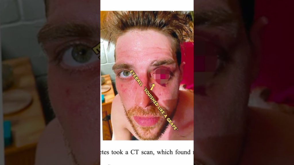 Cop Squished Man's Eyeball 'Like a Grape' | $4 Million Verdict